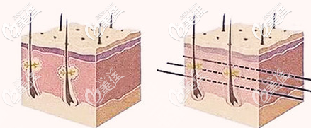 濟(jì)南藝星埋線提升的示意圖
