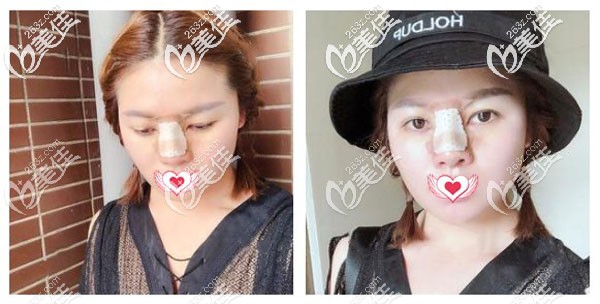 硅膠鼻第7天腫脹消退可以拆線