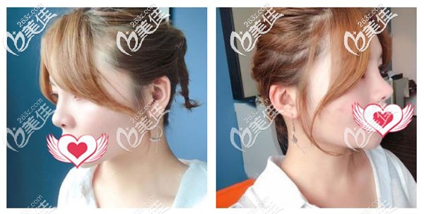 墊鼻尖一個月假體已經(jīng)穩(wěn)定