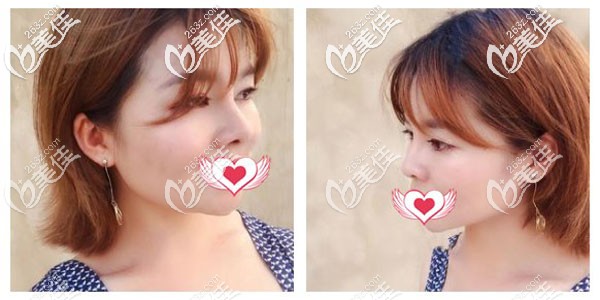 硅膠假體隆鼻20天鼻子還麻，并不代表三個月后會摸到假體出現(xiàn)透光等現(xiàn)象