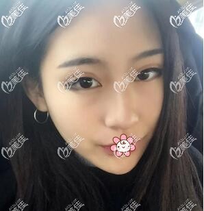 完全恢復了，沒啥后遺癥