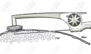 黃金微雕抽脂瘦身原理示意圖 黃金微雕抽脂瘦身原理示意圖