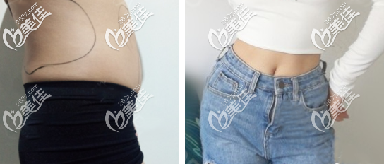 我做的黃金微雕腰腹部環(huán)吸案例效果圖 我做的黃金微雕腰腹部環(huán)吸案例效果圖