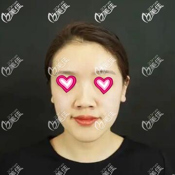 做鼻綜合手術(shù)術(shù)前照 做鼻綜合手術(shù)術(shù)前照