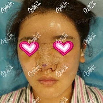 鼻綜合+自體脂肪全臉填充術(shù)后第1天照 鼻綜合+自體脂肪全臉填充術(shù)后第1天照