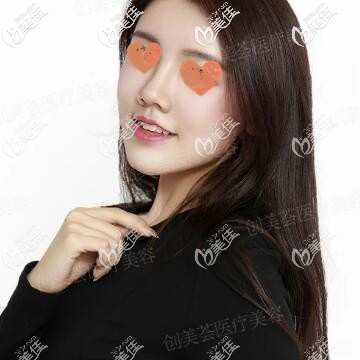 鼻綜合+自體脂肪全臉填充術(shù)后第17天照 鼻綜合+自體脂肪全臉填充術(shù)后第17天照