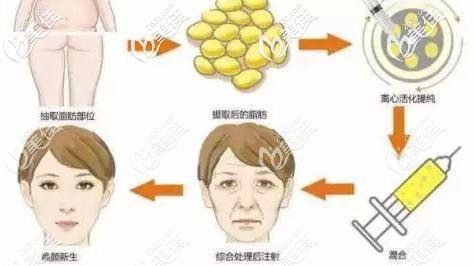 面部自體脂肪填充的過程 面部自體脂肪填充的過程