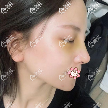 重慶軍科鼻綜合術(shù)后一周 重慶軍科鼻綜合術(shù)后一周