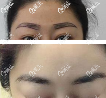 青島有沒(méi)有可以做提眉術(shù)的整形醫(yī)院？華顏美就可以做而且還有案例供你觀賞哦