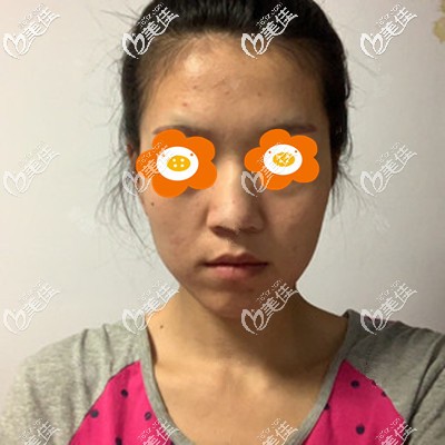 做埋線提升前的我 做埋線提升前的我