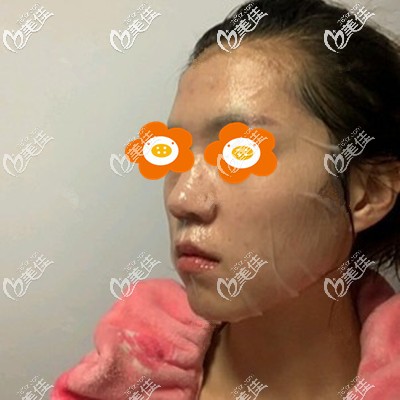 術(shù)后第3天敷著面膜 術(shù)后第3天敷著面膜