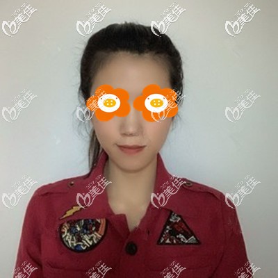 面部埋線提升術(shù)后一周效果 面部埋線提升術(shù)后一周效果