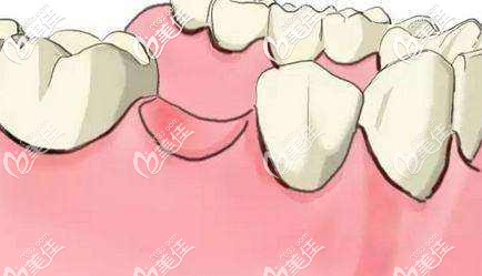 門牙缺失怎么修復(fù)