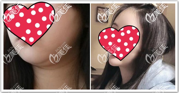 下頜緣抽脂前后對(duì)比圖