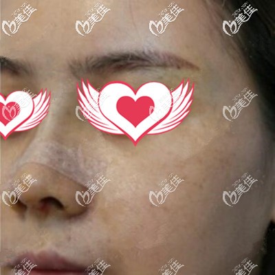 鼻綜合術后3天效果照