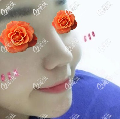 給大家看下長(zhǎng)沙卓而美陳奕霏院長(zhǎng)給我做的膨體鼻綜合效果真好，價(jià)格也優(yōu)惠！