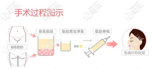 面部脂肪填充手術過程 面部脂肪填充手術過程