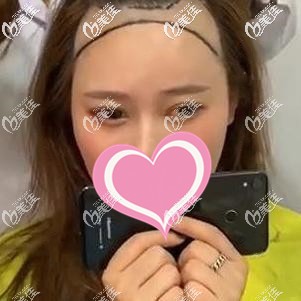 手術前一直后退的發(fā)際線 手術前一直后退的發(fā)際線