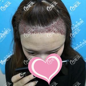 發(fā)際線種植后有輕微種植和流血 發(fā)際線種植后有輕微種植和流血