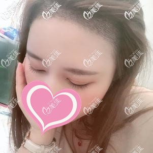 種植發(fā)際線術后30天血痂基本消除 種植發(fā)際線術后30天血痂基本消除