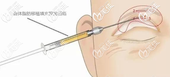 自體脂肪注射眼窩手術(shù)示意圖