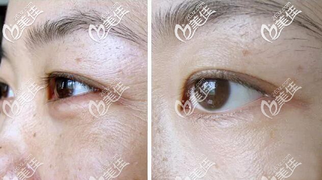 熱瑪吉治療效果 熱瑪吉治療效果