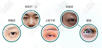 普瀟院長(zhǎng)在做雙眼皮方面的技術(shù)優(yōu)勢(shì) 普瀟院長(zhǎng)在做雙眼皮方面的技術(shù)優(yōu)勢(shì)