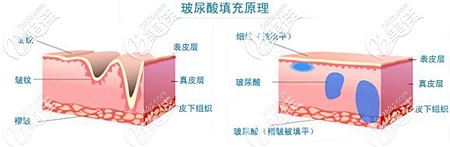 注射玻尿酸除皺的原理 注射玻尿酸除皺的原理