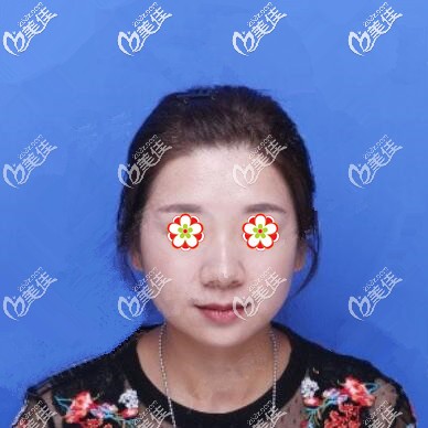 注射玻尿酸填充面部術(shù)前照 注射玻尿酸填充面部術(shù)前照