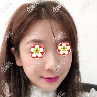 注射玻尿酸瘦臉術(shù)后3天照 注射玻尿酸瘦臉術(shù)后3天照