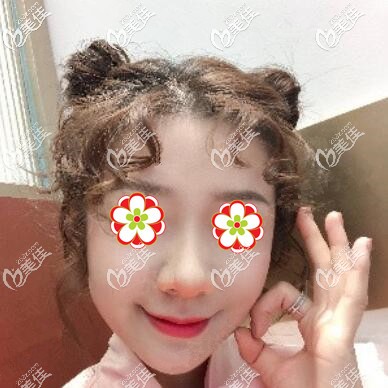 注射玻尿酸+瘦臉術(shù)后半個月效果照 注射玻尿酸+瘦臉術(shù)后半個月效果照