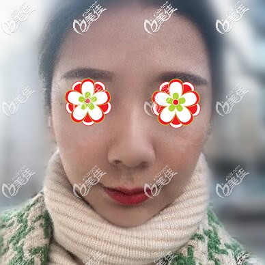 打玻尿酸+瘦臉術(shù)后1個月恢復(fù)照 打玻尿酸+瘦臉術(shù)后1個月恢復(fù)照