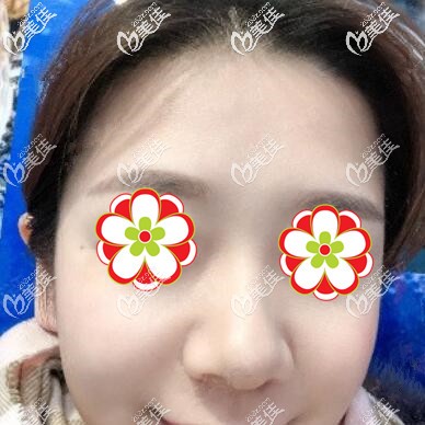 注射玻尿酸瘦臉術(shù)后2個月時的效果照 注射玻尿酸瘦臉術(shù)后2個月時的效果照