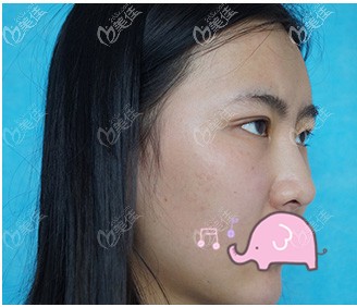 耳軟骨隆鼻術(shù)前照片 耳軟骨隆鼻術(shù)前照片