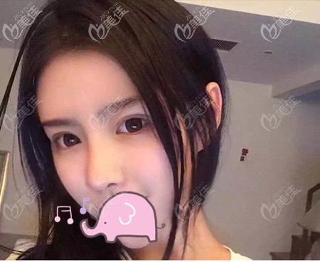 在瀘州橙美做了耳軟骨隆鼻后,我對“鼻子做耳軟骨能管一輩子嗎”有明確答案