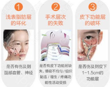 重慶鄭荃麗格脂肪填充失敗修復 重慶鄭荃麗格脂肪填充失敗修復