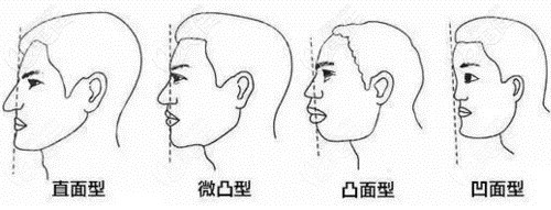 鼻基底凹陷的幾種情況 鼻基底凹陷的幾種情況
