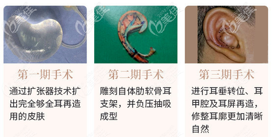 耳再造手術(shù)治療過程圖