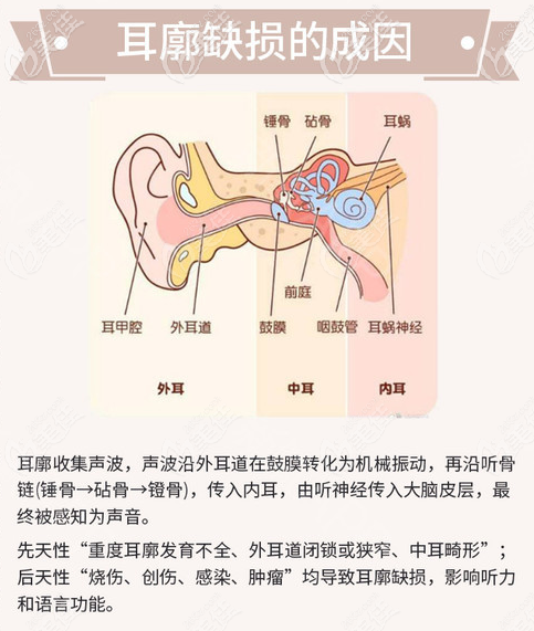 耳廓缺損的原因