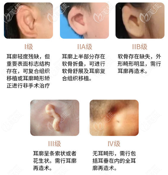 先天性小耳畸形幾種類型圖