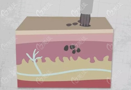 紋身形成的過(guò)程原理