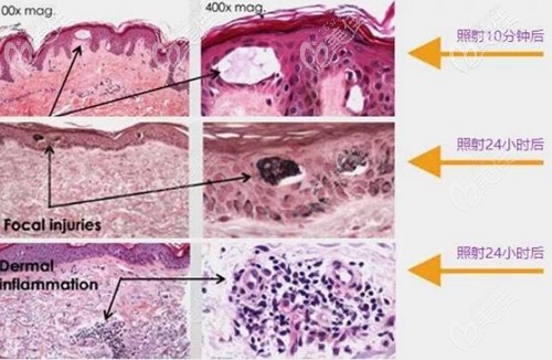 超皮秒祛紋身的過(guò)程
