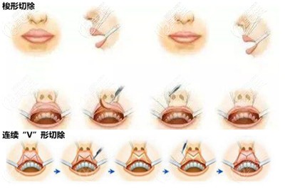 厚唇改薄手術(shù)的切口設(shè)計(jì)方案 厚唇改薄手術(shù)的切口設(shè)計(jì)方案