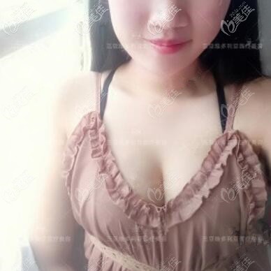 自體脂肪隆胸術(shù)后10天恢復(fù)照 自體脂肪隆胸術(shù)后10天恢復(fù)照