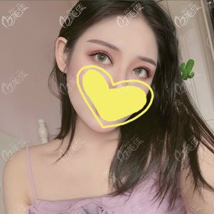 打聽到武漢雙眼皮修復(fù)厲害的醫(yī)生余國勝坐診五洲萊美,于是慕名找他做了雙眼皮二次修復(fù)