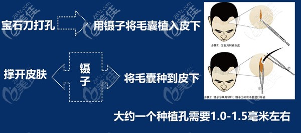 植發(fā)手術(shù)種植過(guò)程