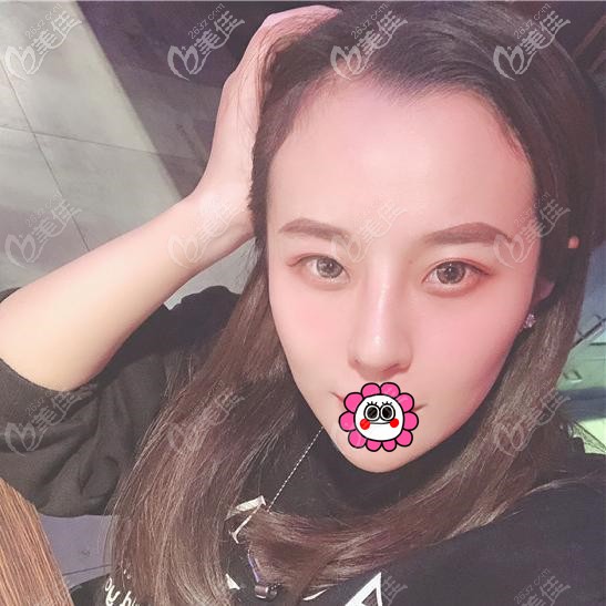 肋軟骨隆鼻恢復(fù)半個月