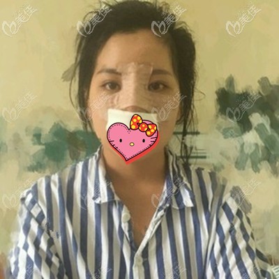 做完鼻部多項術(shù)后照