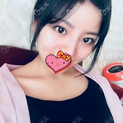 做完肋骨鼻1個月鼻子的變化