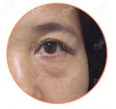 松弛型眼袋